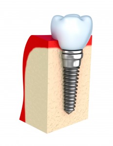 Clarksville, Tennessee dental implants